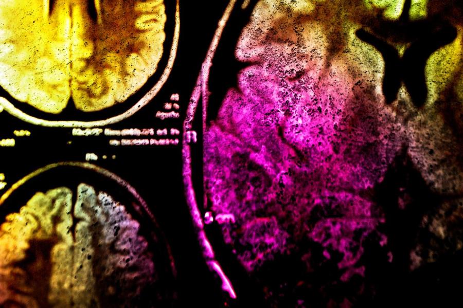 Онкологи разработали метод для обнаружения рака мозга с точностью до 100%